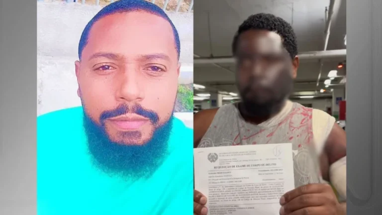 Homem tem rosto deformado após mulher jogar água quente enquanto dormia