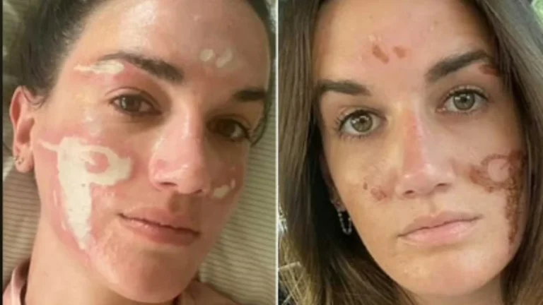 Cliente acusa esteticista das celebridades de causar queimaduras em seu rosto após peeling