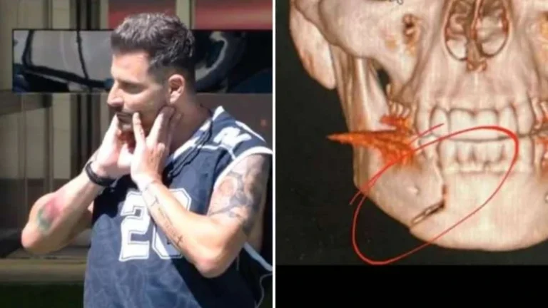 BBB26: Sequela de Henri Castelli pode ter causado convulsão na Prova do Líder