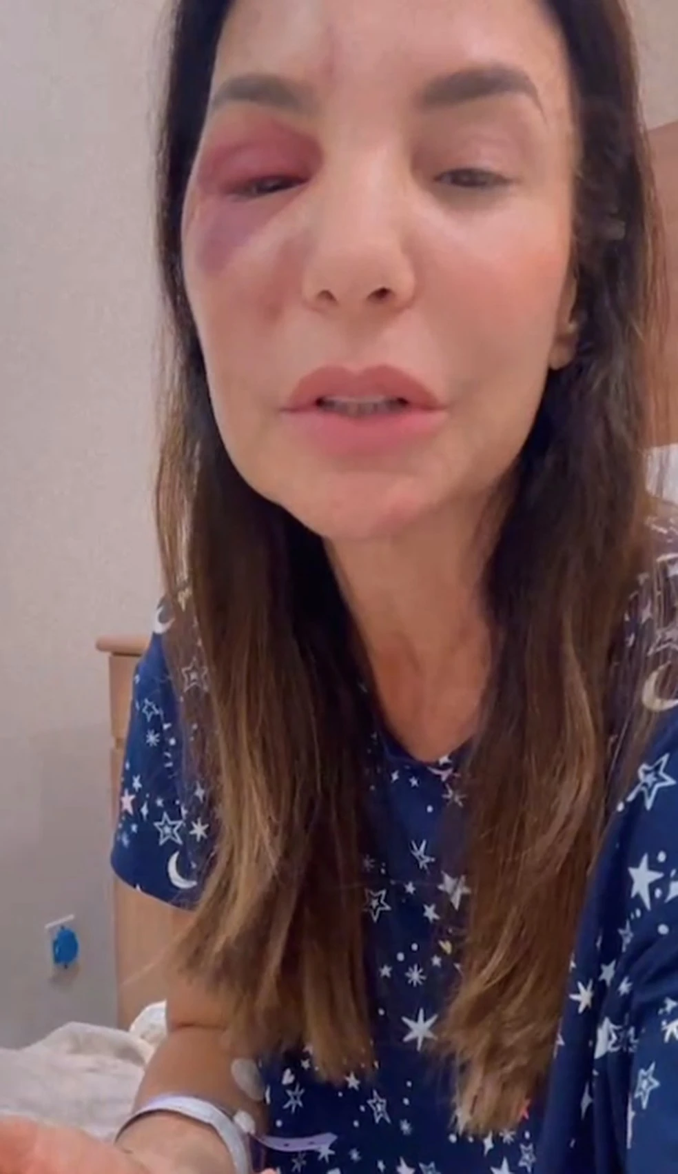Ivete Sangalo fala sobre cirurgia que fez no rosto após queda no banheiro: Houve uma ruptura de osso