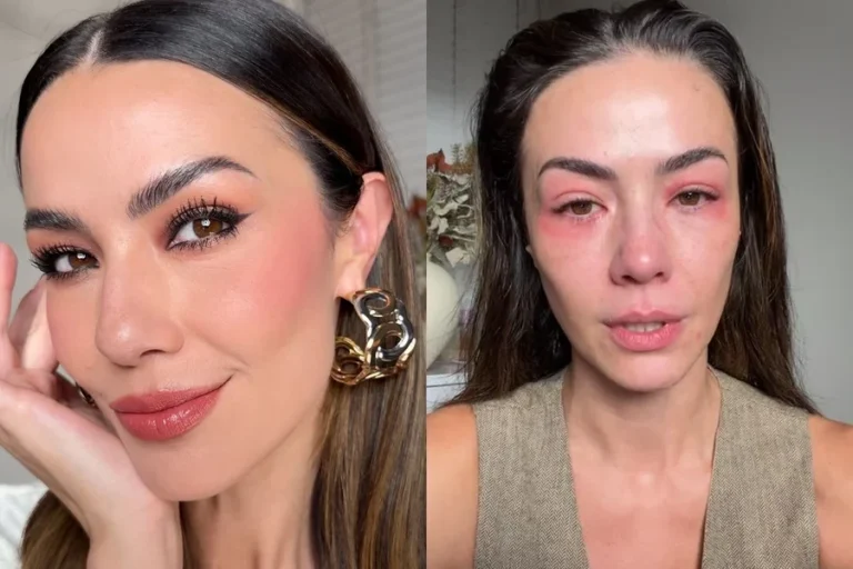 Influencer revela forte crise alérgica e expõe como está o rosto. Veja