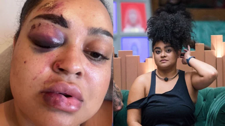 Ex-BBB Rízia Cerqueira detalha acidente e mostra rosto machucado
