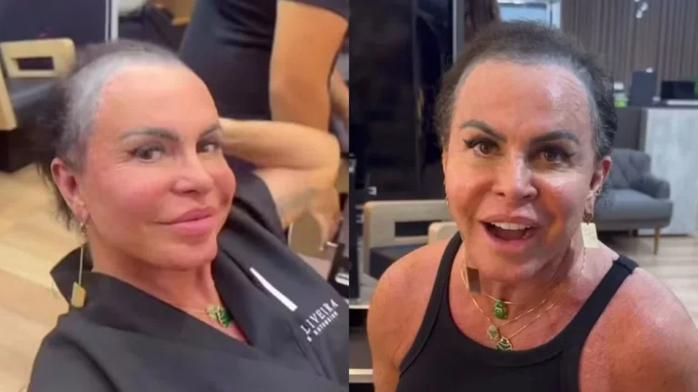 Gretchen surge sem prótese capilar e detalha tratamento contra alopecia
