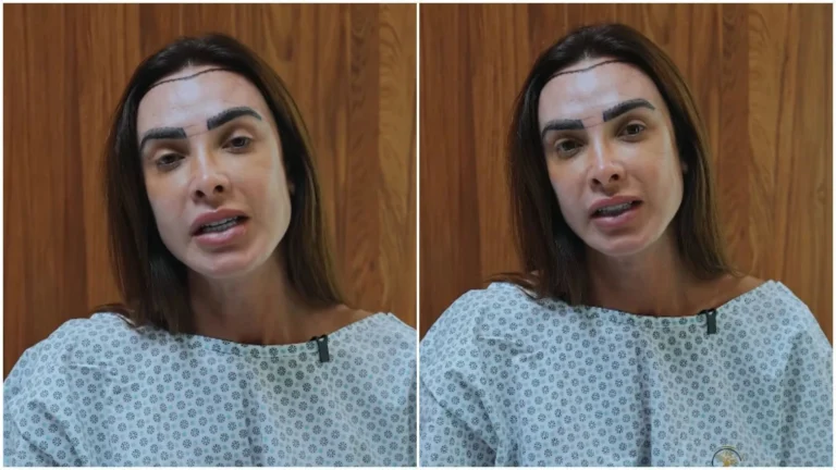 Nicole Bahls faz transplante capilar e declara: “Mais feliz”